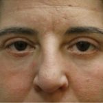 Blepharoplasty Before & After Patient #8801