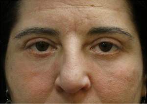 Blepharoplasty Before & After Patient #8801