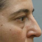 Blepharoplasty Before & After Patient #8801