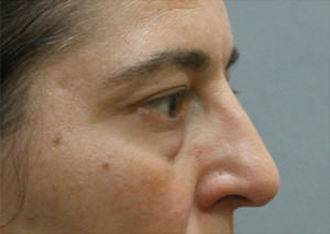 Blepharoplasty Before & After Patient #8801