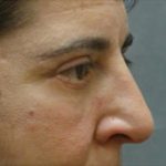 Blepharoplasty Before & After Patient #8801