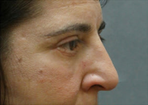 Blepharoplasty Before & After Patient #8801