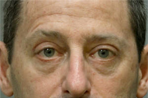 Blepharoplasty Before & After Patient #8806