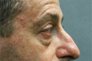 Blepharoplasty Before & After Patient #8806