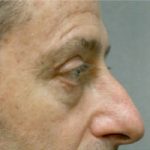 Blepharoplasty Before & After Patient #8806