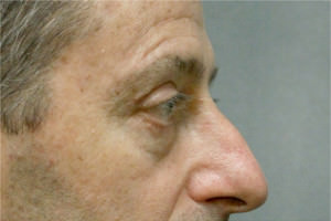 Blepharoplasty Before & After Patient #8806