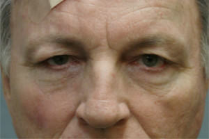 Blepharoplasty Before & After Patient #8813