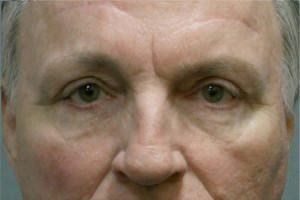 Blepharoplasty Before & After Patient #8813