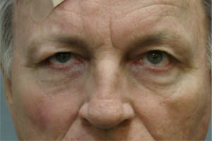 Blepharoplasty Before & After Patient #8813