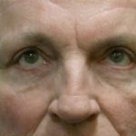 Blepharoplasty Before & After Patient #8813
