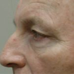 Blepharoplasty Before & After Patient #8813