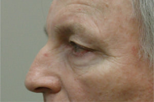 Blepharoplasty Before & After Patient #8813