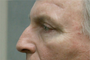 Blepharoplasty Before & After Patient #8813