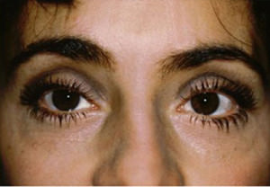 Blepharoplasty Before & After Patient #8820