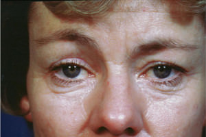 Blepharoplasty Before & After Patient #8826