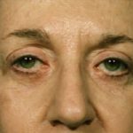 Blepharoplasty Before & After Patient #8829