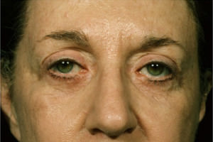 Blepharoplasty Before & After Patient #8829