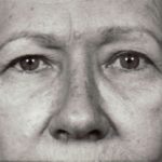 Blepharoplasty Before & After Patient #8832