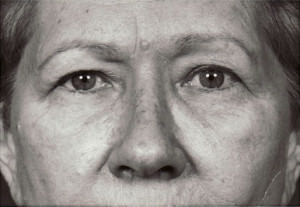 Blepharoplasty Before & After Patient #8832