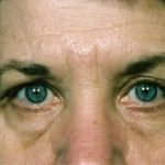 Blepharoplasty Before & After Patient #8835