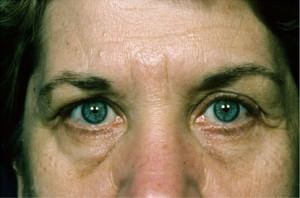 Blepharoplasty Before & After Patient #8835