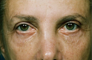 Blepharoplasty Before & After Patient #8835