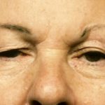 Blepharoplasty Before & After Patient #8838