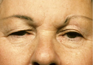 Blepharoplasty Before & After Patient #8838