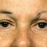 Blepharoplasty Before & After Patient #8838