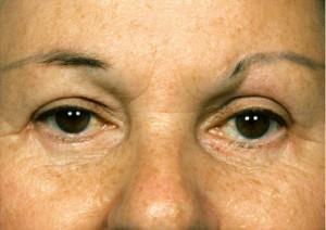 Blepharoplasty Before & After Patient #8838