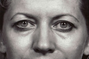 Blepharoplasty Before & After Patient #8847