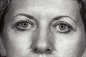 Blepharoplasty Before & After Patient #8847
