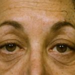 Blepharoplasty Before & After Patient #8850