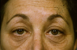 Blepharoplasty Before & After Patient #8850
