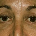 Blepharoplasty Before & After Patient #8850