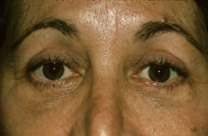 Blepharoplasty Before & After Patient #8850