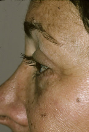 Blepharoplasty Before & After Patient #8850