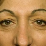 Blepharoplasty Before & After Patient #8855