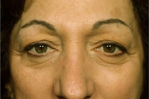 Blepharoplasty Before & After Patient #8855