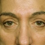Blepharoplasty Before & After Patient #8855