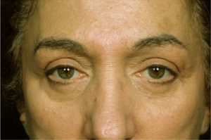 Blepharoplasty Before & After Patient #8855