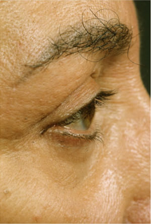 Blepharoplasty Before & After Patient #8855