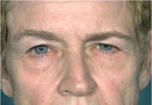 Blepharoplasty Before & After Patient #8863