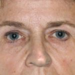 Blepharoplasty Before & After Patient #8863