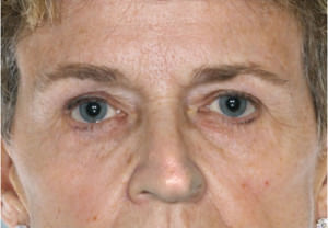 Blepharoplasty Before & After Patient #8863