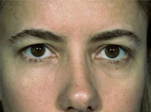 Blepharoplasty Before & After Patient #8866