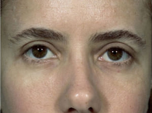 Blepharoplasty Before & After Patient #8866