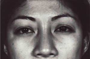 Blepharoplasty Before & After Patient #8871