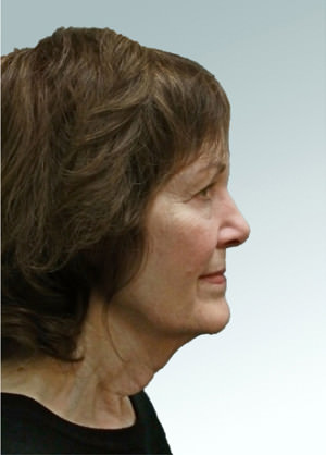 Facelift Before & After Patient #9239