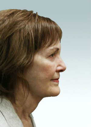 Facelift Before & After Patient #9239